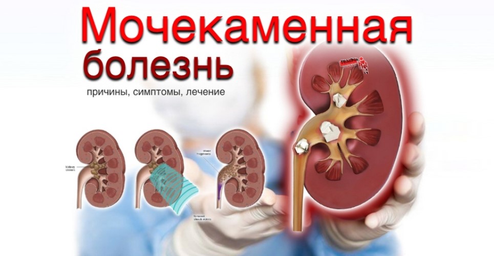 Дробление крупных и коралловидных камней почек - стоимость операции, лечение в СПб