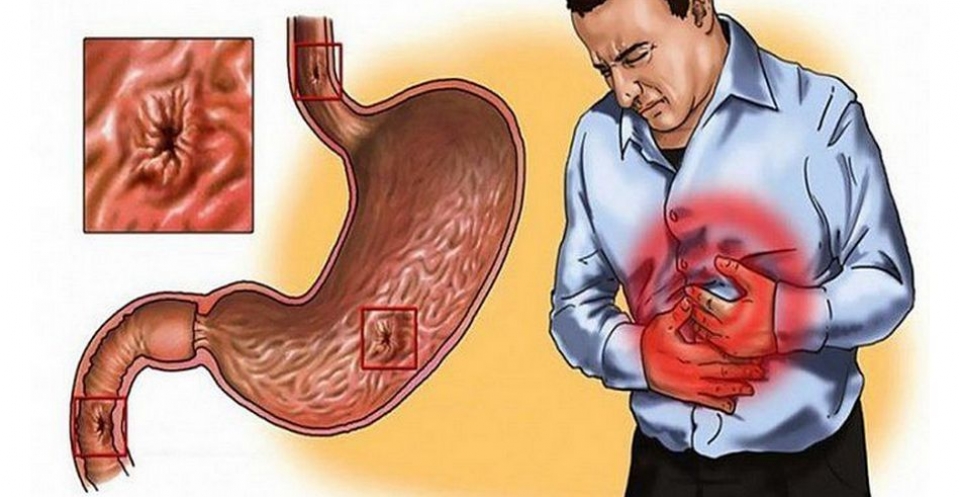 Заболевания желудочно-кишечного тракта (ЖКТ)